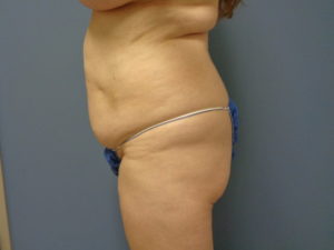 Abdominoplasty Before & After Pictures in Nashville, TN