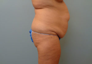 Tummy Tuck Before & After Pictures in Nashville, TN