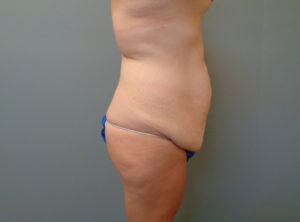 Abdominoplasty Before & After Pictures in Nashville, TN