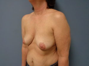 Breast Reconstruction-Implant Based Before & After Pictures in Nashville, TN