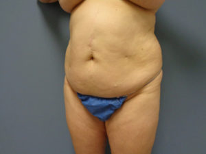 Abdominoplasty Before & After Pictures in Nashville, TN