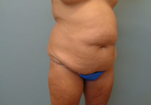 Tummy Tuck Before & After Pictures in Nashville, TN