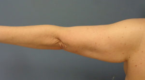 Arm Lift Before & After Pictures in Nashville, TN