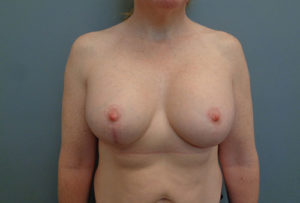 Breast Augmentation with lift Before & After Pictures in Nashville, TN