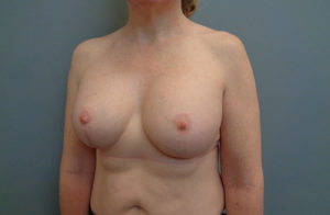 Breast Augmentation with lift