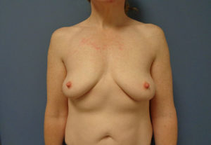 Breast Augmentation with lift