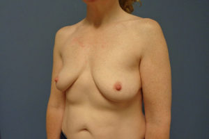 Breast Augmentation with lift Before & After Pictures in Nashville, TN