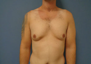 Gynecomastia