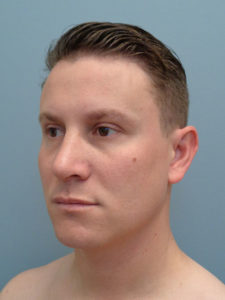 Rhinoplasty Before & After Pictures in Nashville, TN