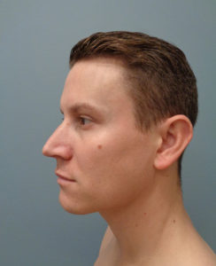 Rhinoplasty Before & After Pictures in Nashville, TN