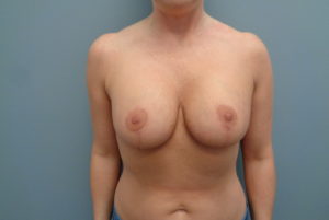 Breast Augmentation with lift Before & After Pictures in Nashville, TN