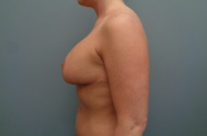 Breast Augmentation with lift Before & After Pictures in Nashville, TN