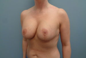 Breast Augmentation with lift Before & After Pictures in Nashville, TN