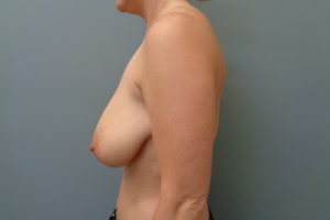 Breast Augmentation with lift Before & After Pictures in Nashville, TN