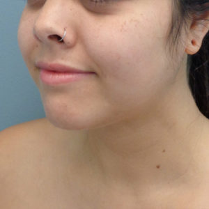 Chin Augmentation Before & After Pictures in Nashville, TN