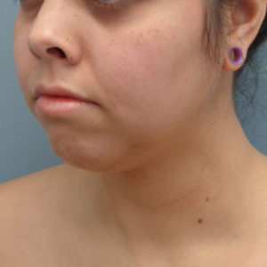 Chin Augmentation Before & After Pictures in Nashville, TN