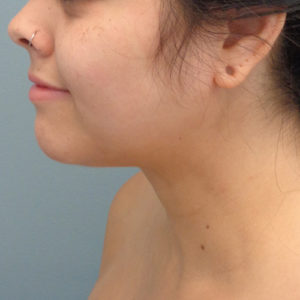 Chin Augmentation Before & After Pictures in Nashville, TN