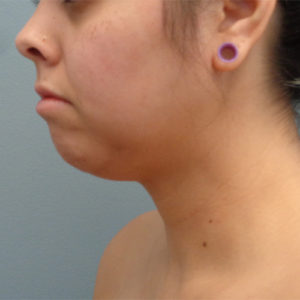 Chin Augmentation Before & After Pictures in Nashville, TN