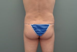 Butt Augmentation Before & After Pictures in Nashville, TN