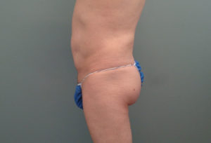 Butt Augmentation Before & After Pictures in Nashville, TN