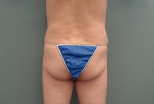 Butt Augmentation Before & After Pictures in Nashville, TN