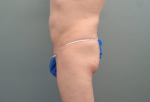 Butt Augmentation Before & After Pictures in Nashville, TN