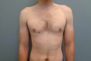 Gynecomastia Before & After Pictures in Nashville, TN