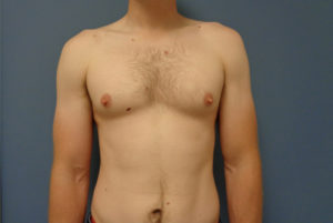 Gynecomastia Before & After Pictures in Nashville, TN