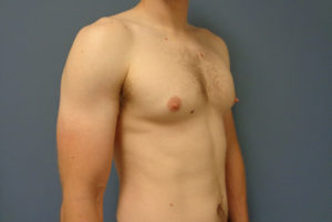 Gynecomastia Before & After Pictures in Nashville, TN