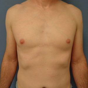 Gynecomastia