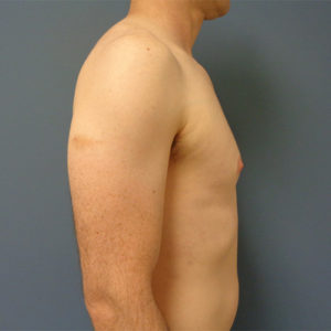 Gynecomastia