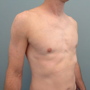 Gynecomastia