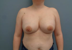 Implant Based reconstruction Before & After Pictures in Nashville, TN