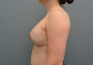 Implant Based reconstruction Before & After Pictures in Nashville, TN