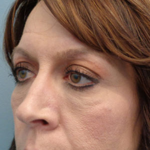 Blepharoplasty Before & After Pictures in Nashville, TN