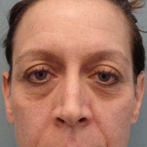 Blepharoplasty Before & After Pictures in Nashville, TN