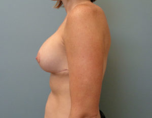 Breast Augmentation with Lift Before & After Pictures in Nashville, TN