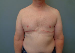 Gynecomastia Before & After Pictures in Nashville, TN