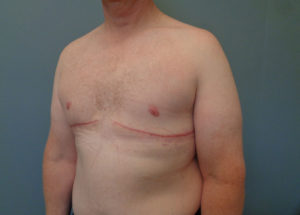 Gynecomastia Before & After Pictures in Nashville, TN