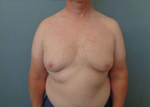 Gynecomastia Before & After Pictures in Nashville, TN