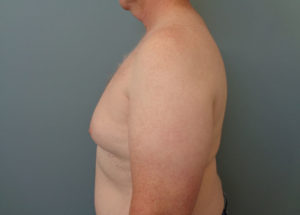 Gynecomastia Before & After Pictures in Nashville, TN