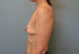 Breast Augmentation Before & After Pictures in Nashville, TN