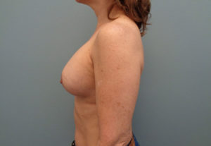 Breast Augmentation Before & After Pictures in Nashville, TN