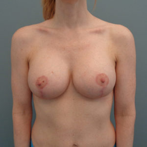 Breast Augmentation Before & After Pictures in Nashville, TN