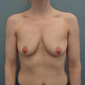 Breast Augmentation Before & After Pictures in Nashville, TN