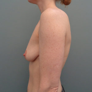 Breast Augmentation Before & After Pictures in Nashville, TN