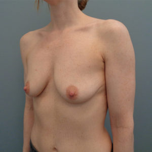 Breast Augmentation Before & After Pictures in Nashville, TN