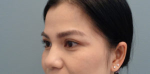 Blepharoplasty Before & After Pictures in Nashville, TN