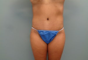 Abdominoplasty Before & After Pictures in Nashville, TN