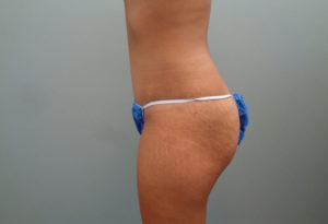 Abdominoplasty Before & After Pictures in Nashville, TN